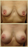 Salt Lake City Breast Augmentation patient photos
