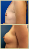 Salt Lake City Breast Augmentation patient photos
