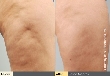 Salt Lake City cellulaze before and after patient photos